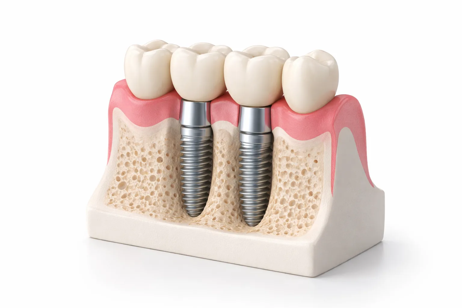Implant-supported prosthodontic restorations placeholder image