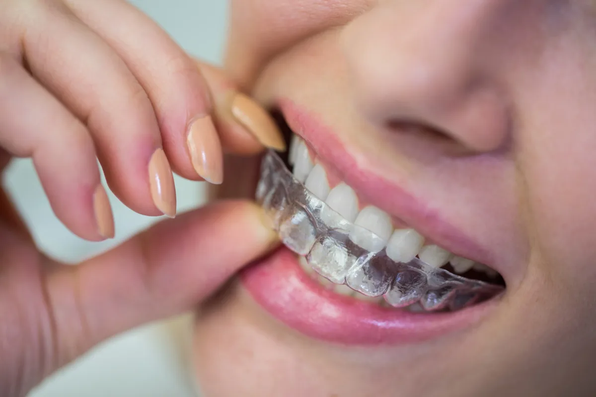 Invisalign braces case photo 3