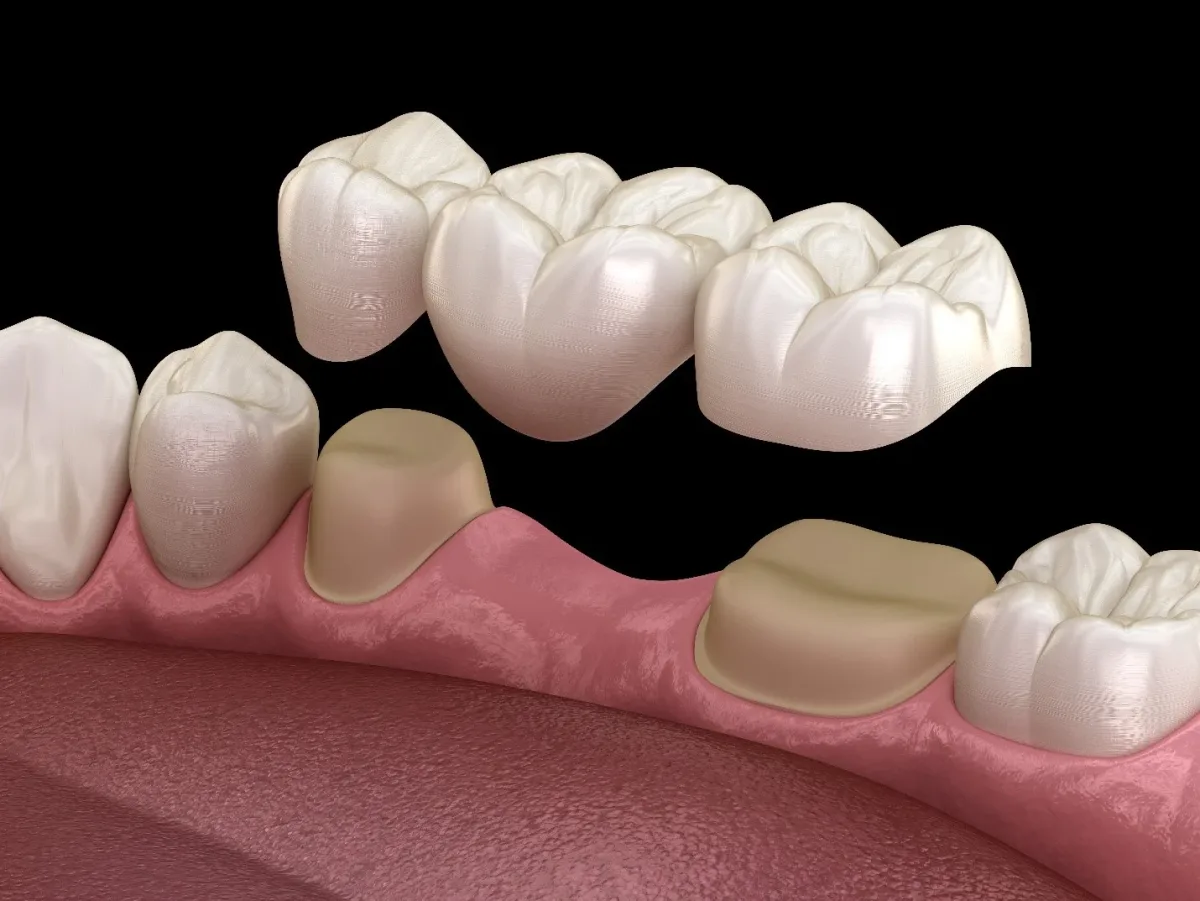 Dental bridges to replace missing teeth at TrueSmile, Bengaluru