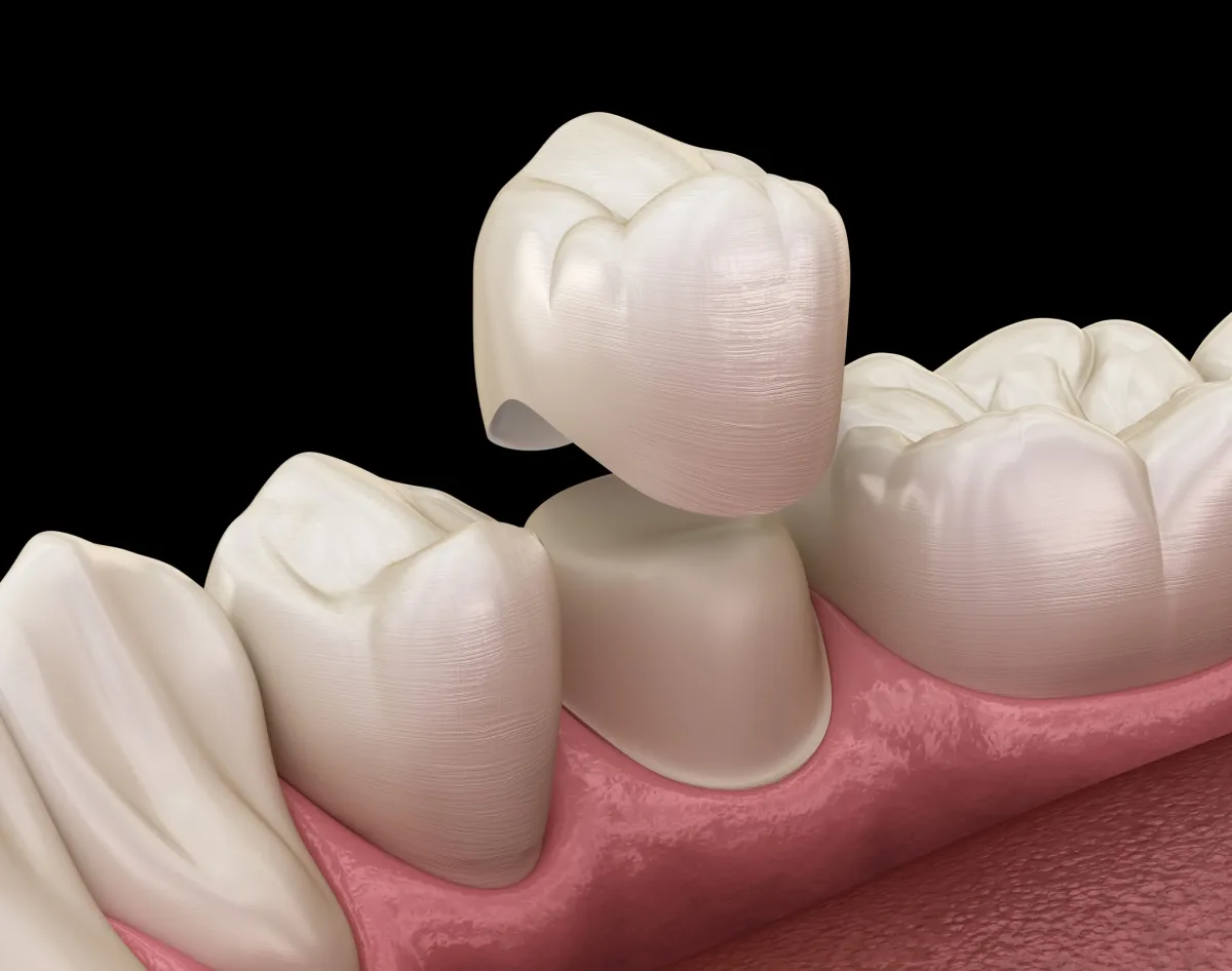 Dental crowns to restore tooth shape at TrueSmile, Bengaluru