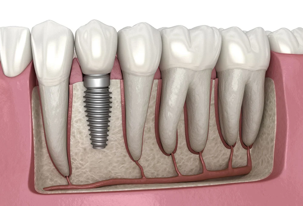 Dental implants for permanent tooth replacement at TrueSmile, Bengaluru