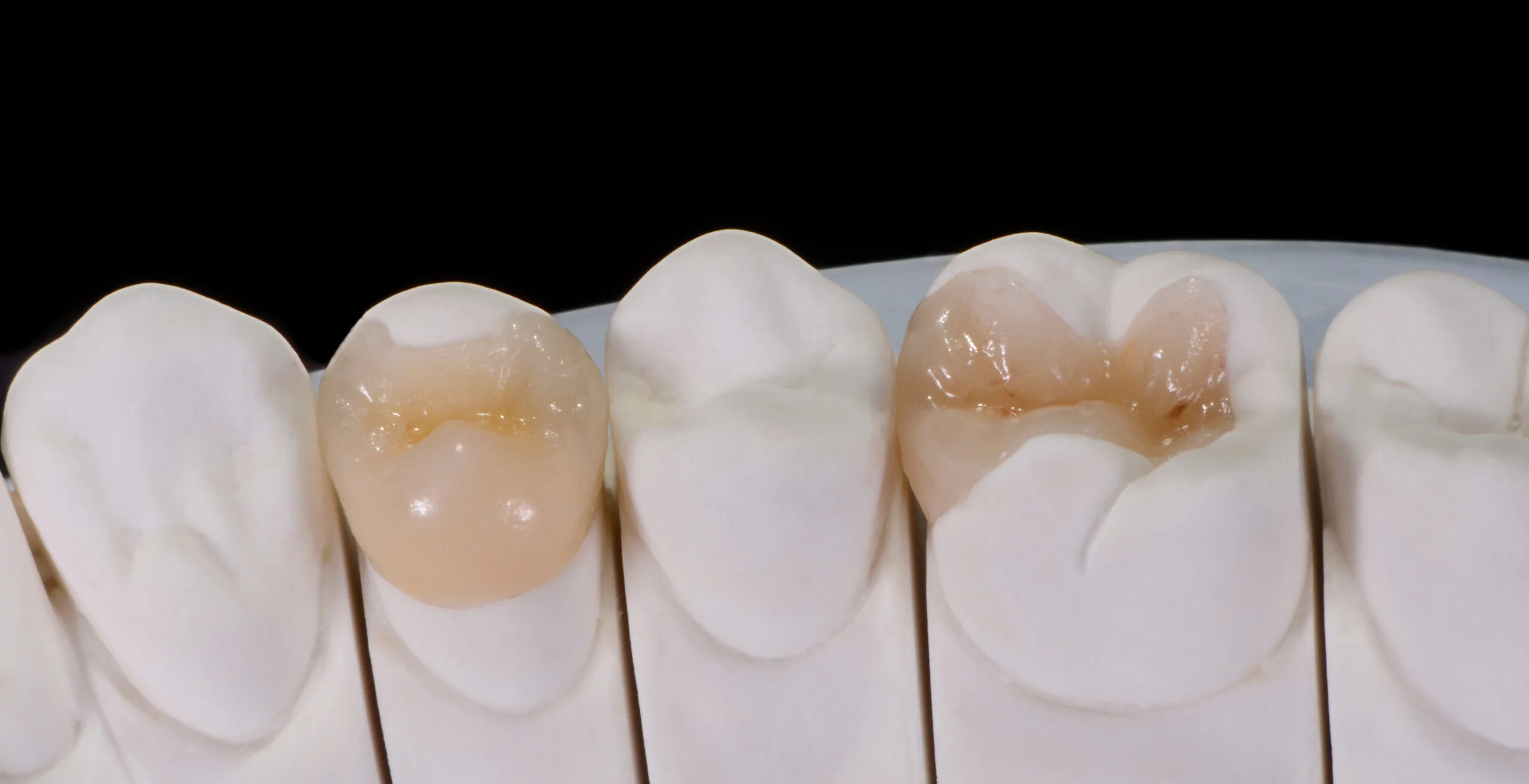 Dental restorations — crowns, inlays, onlays at TrueSmile, Bengaluru