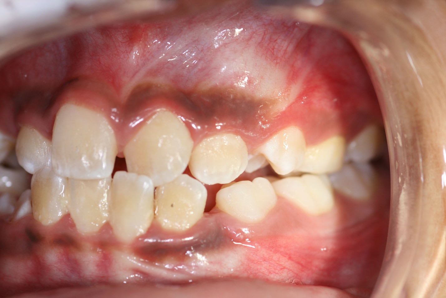 Illustration placeholder for deciduous orthodontic treatment steps
