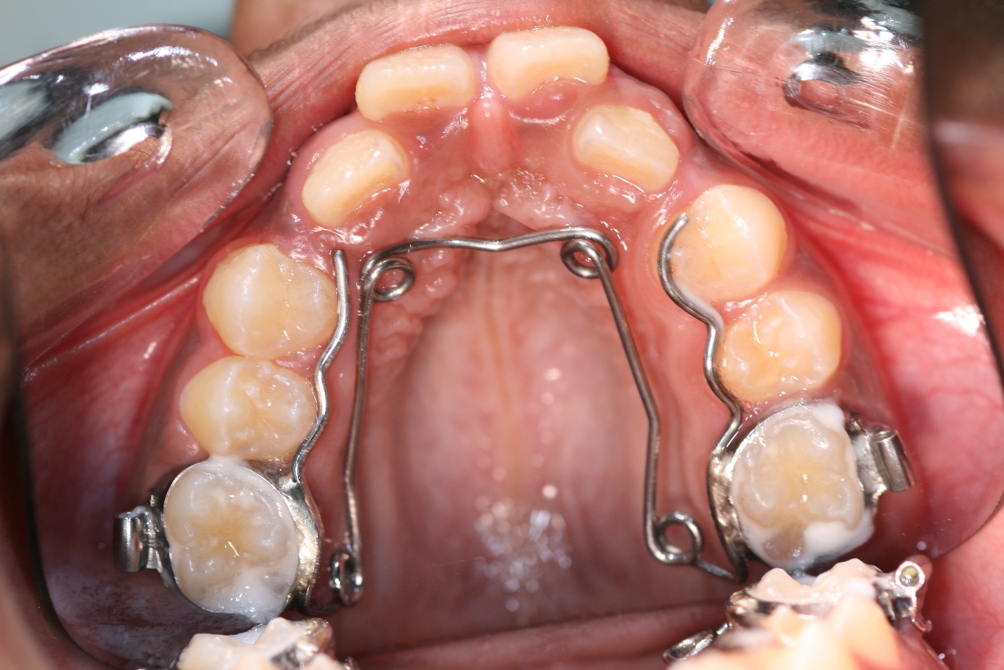 Illustration placeholder for deciduous orthodontic treatment steps