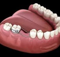 Illustration placeholder for deciduous orthodontic treatment steps