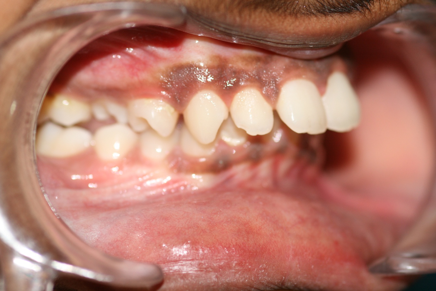 Illustration placeholder for deciduous orthodontic treatment steps