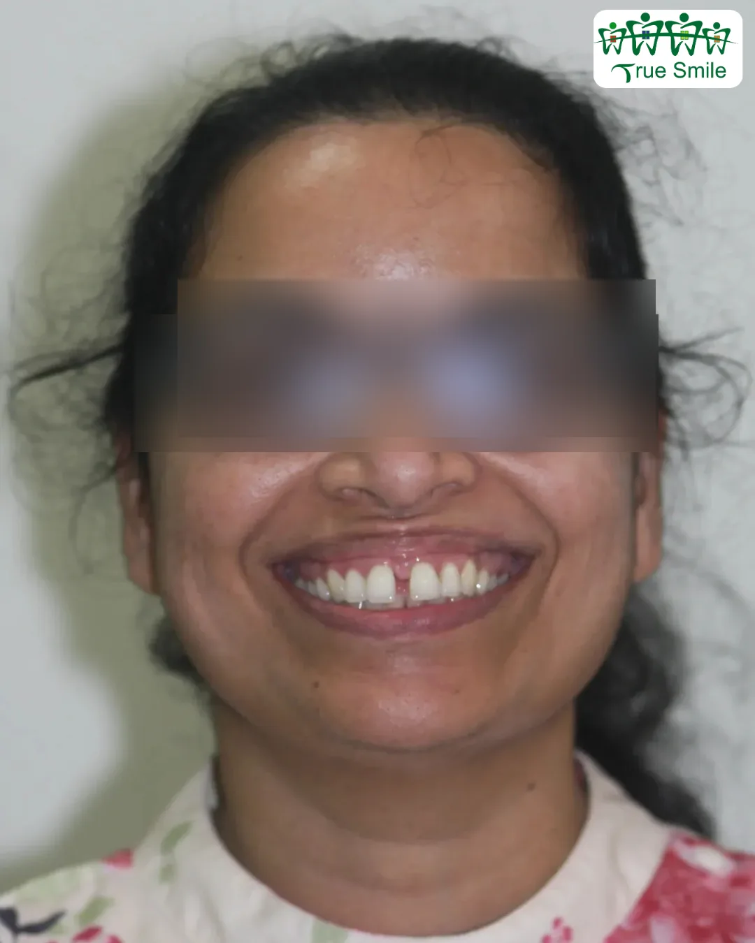 Case 1 — before Invisalign treatment