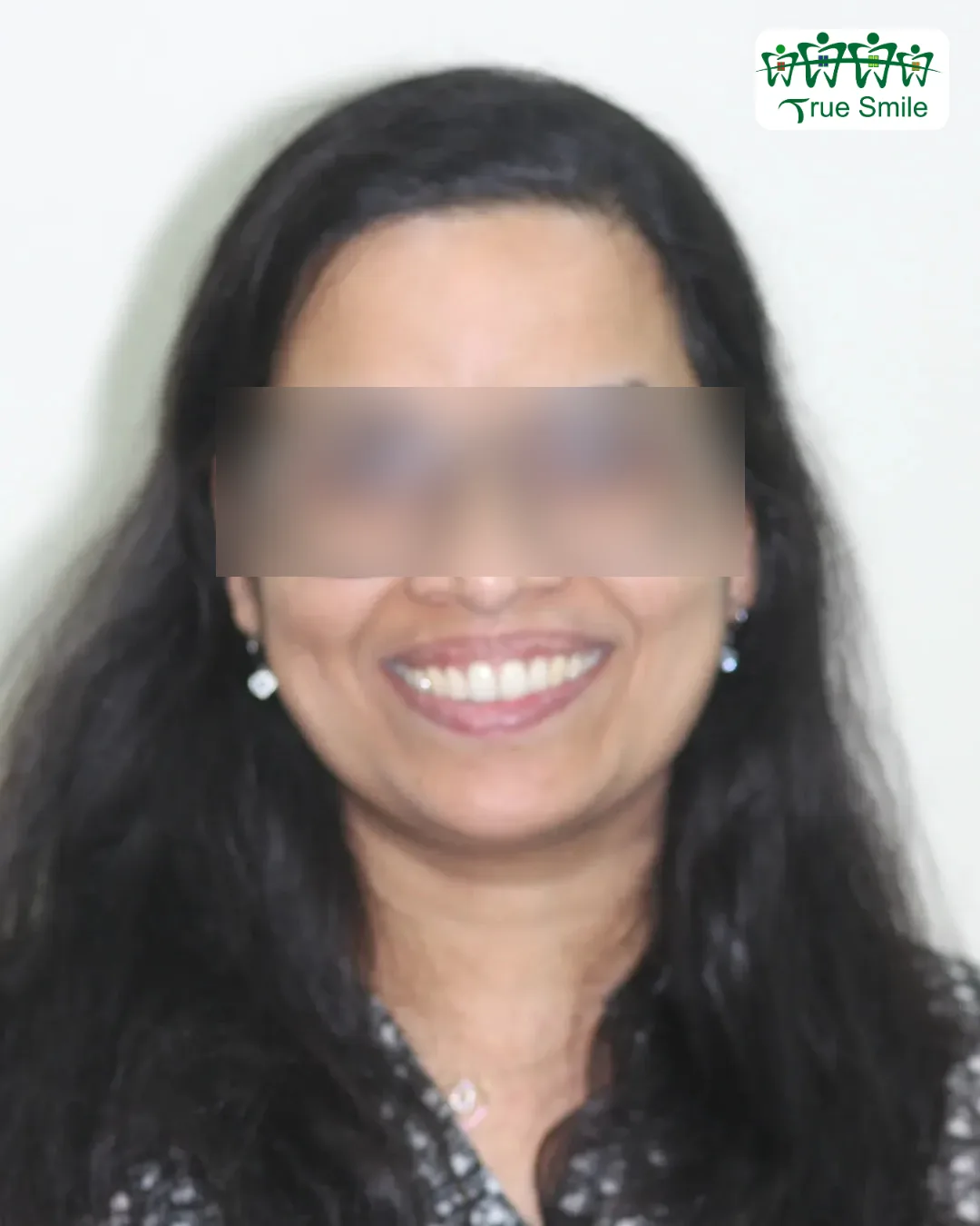 Case 1 — after Invisalign treatment