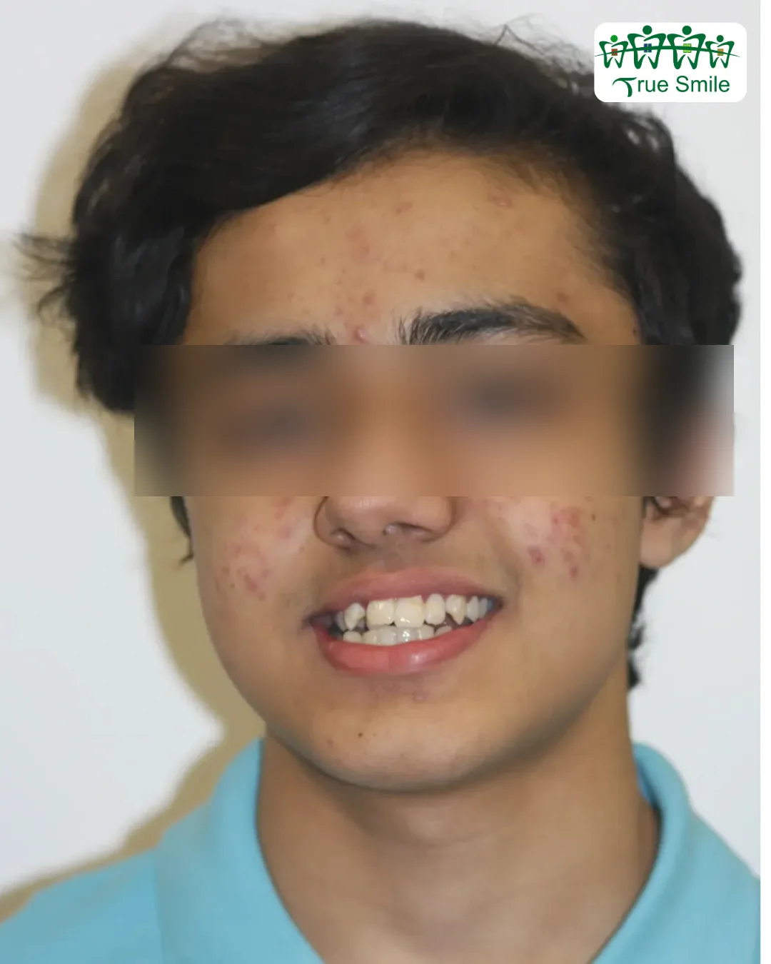 Case 3 — before Invisalign treatment
