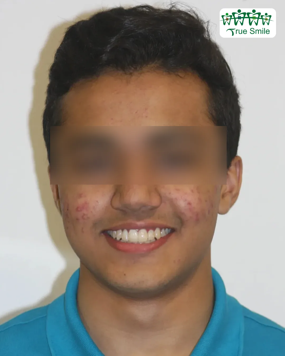 Case 3 — after Invisalign treatment