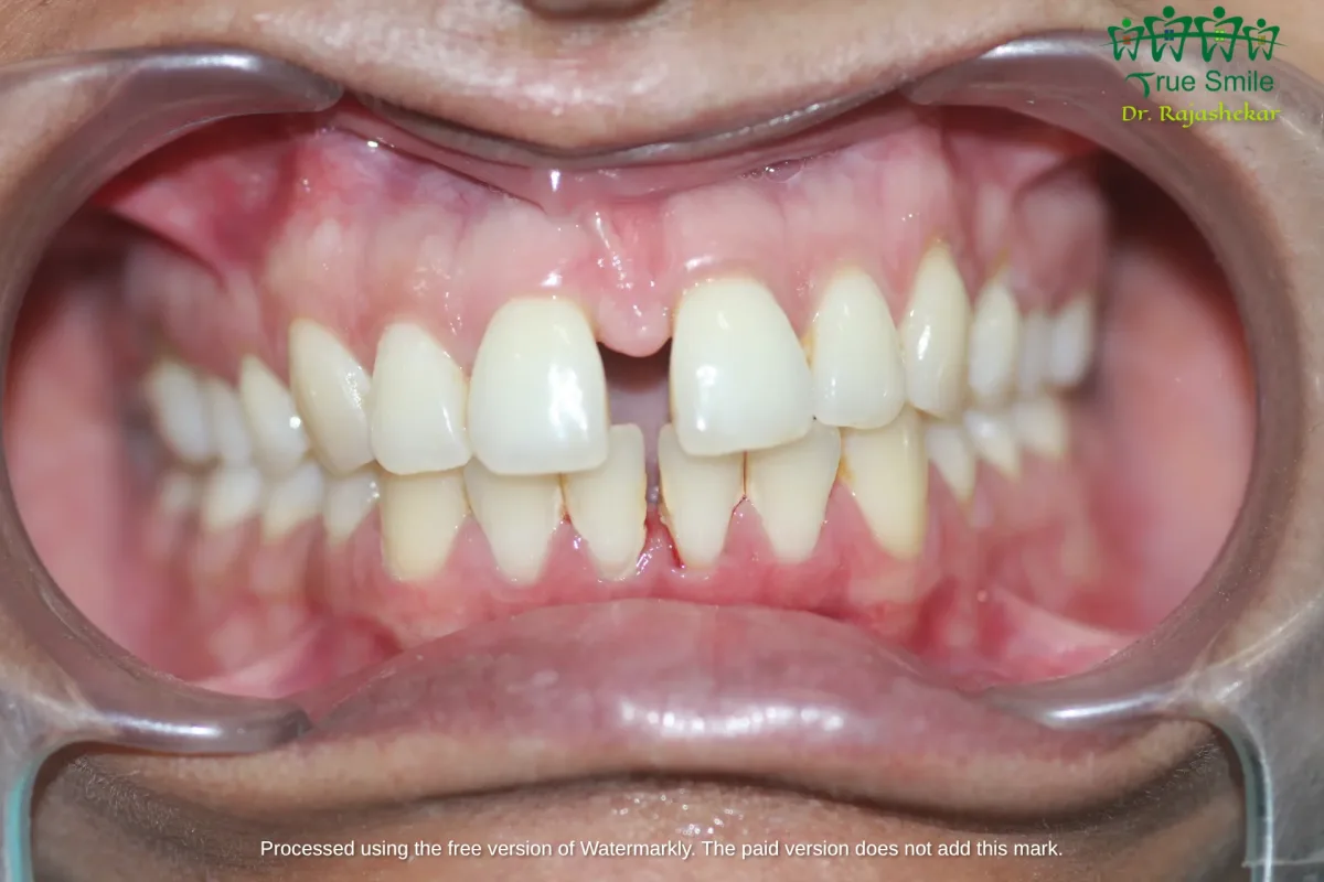 Case 2 — before Invisalign treatment