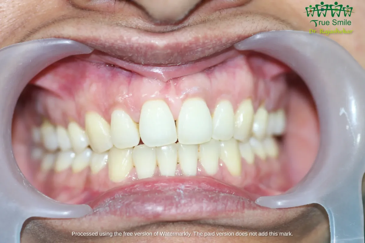 Case 2 — after Invisalign treatment