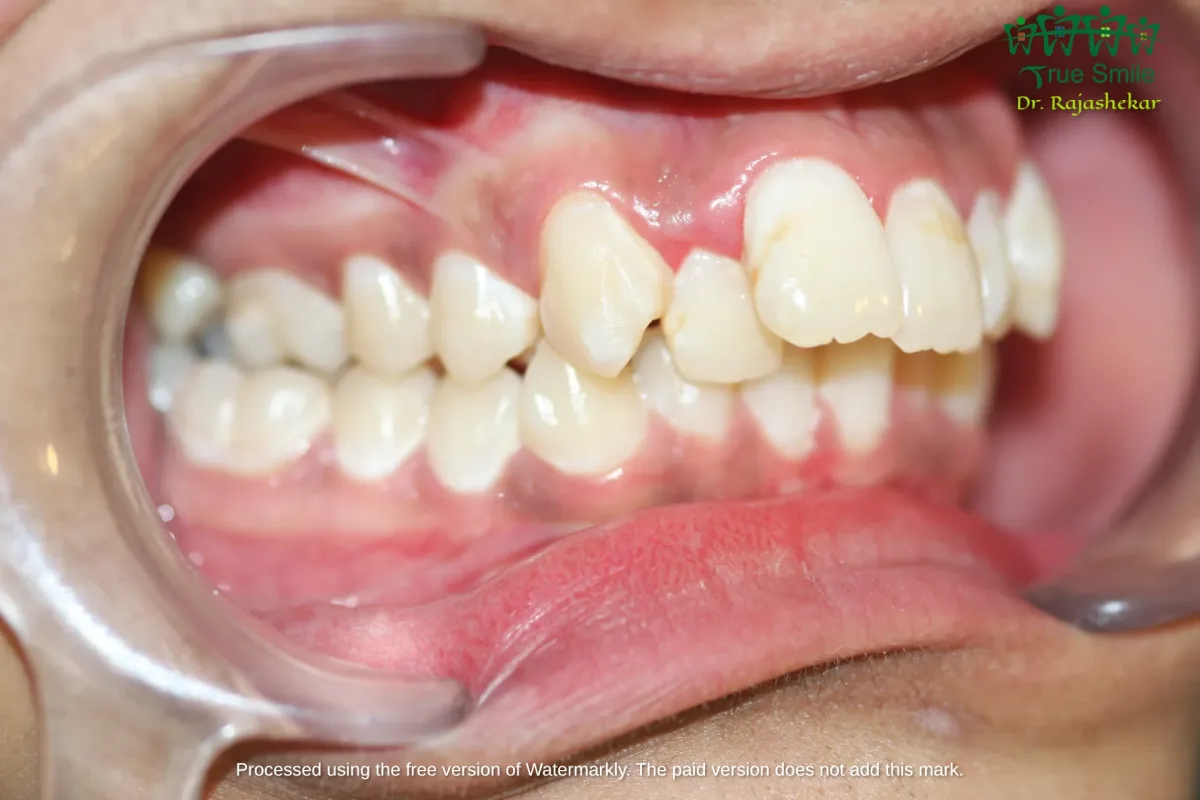 Case 4 — before Invisalign treatment