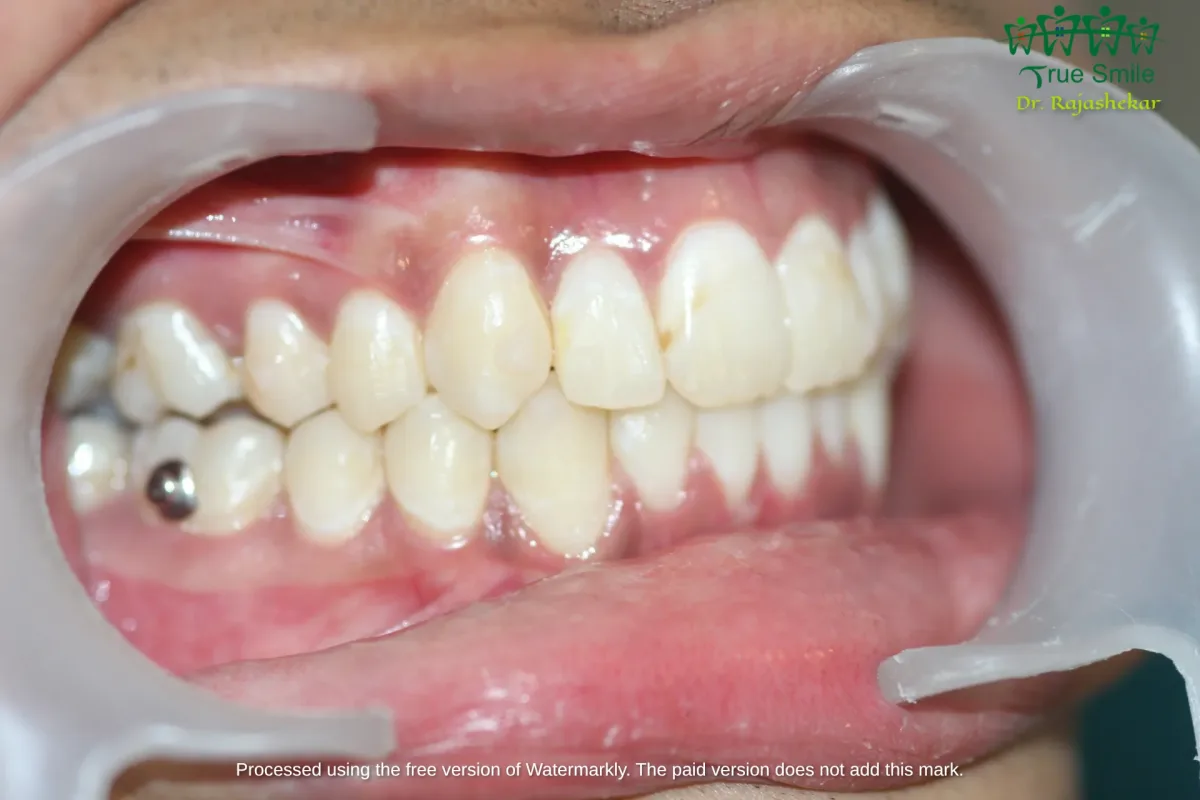Case 4 — after Invisalign treatment