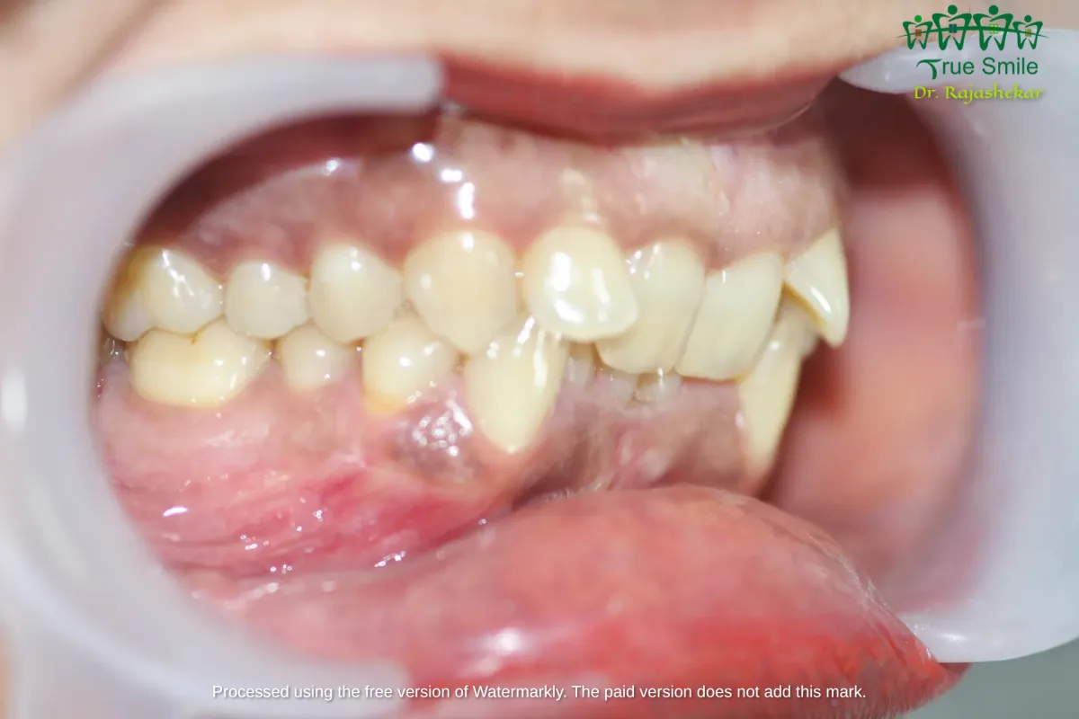 Case 5 — before Invisalign treatment