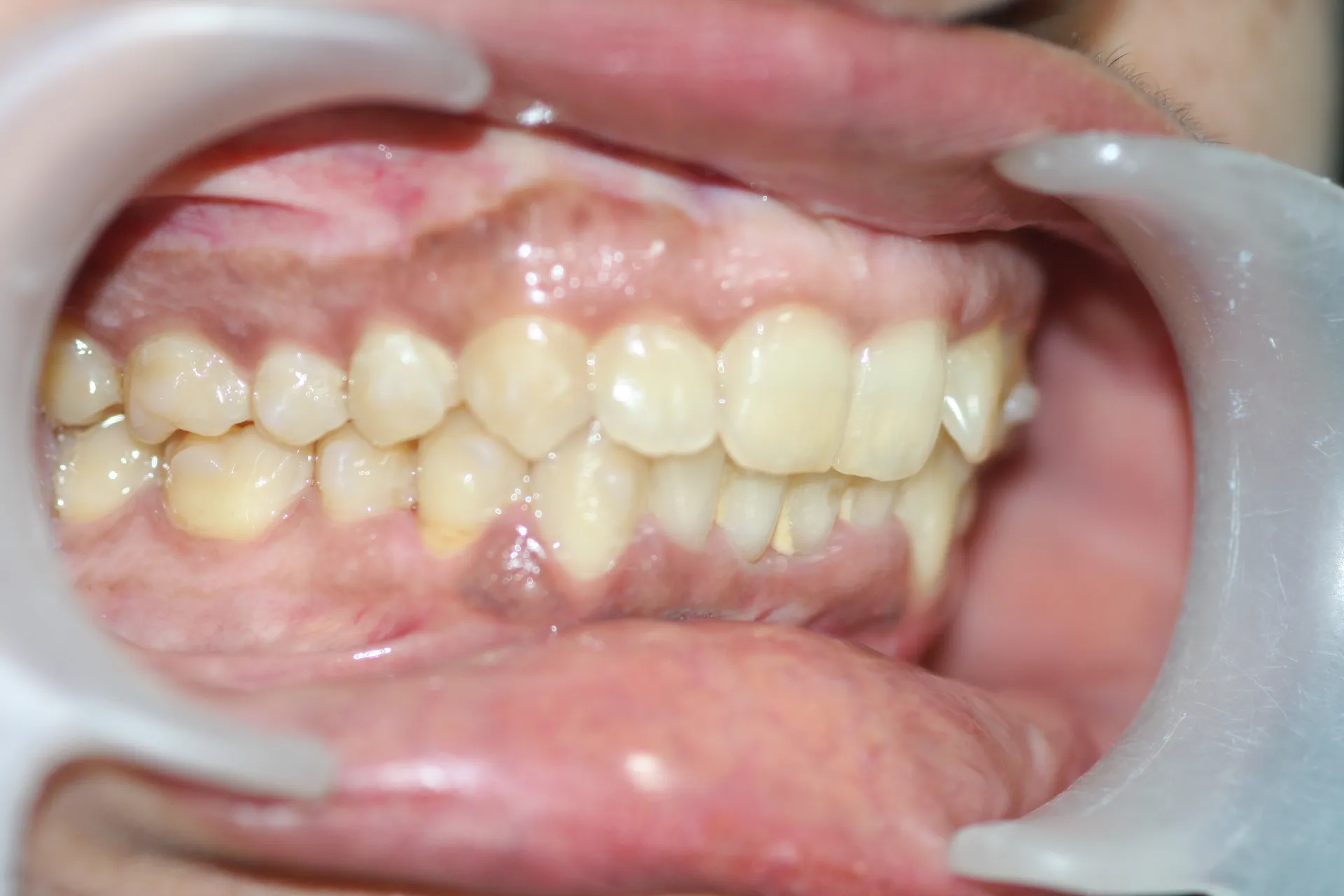 Case 5 — after Invisalign treatment