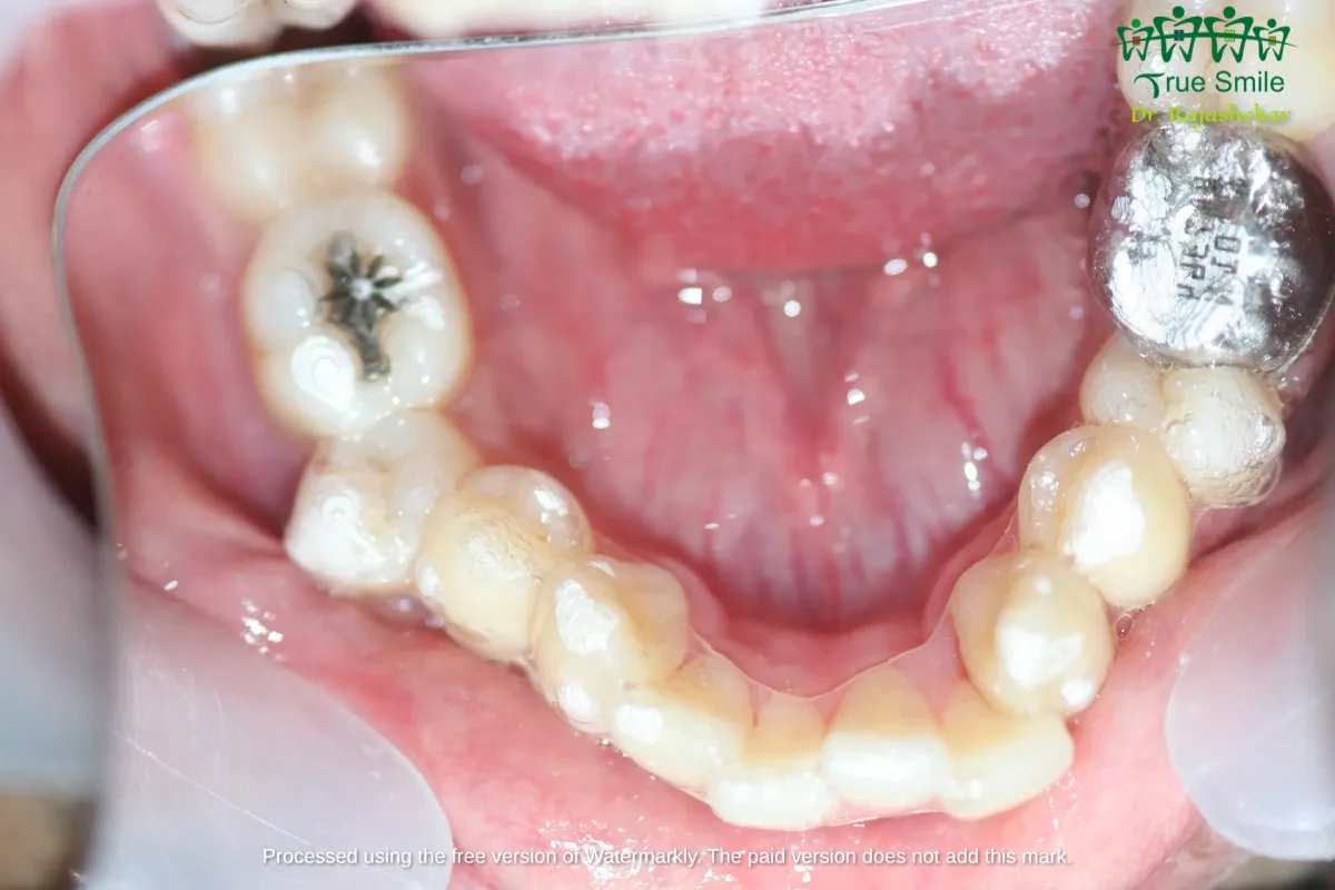 Case 6 — before Invisalign treatment
