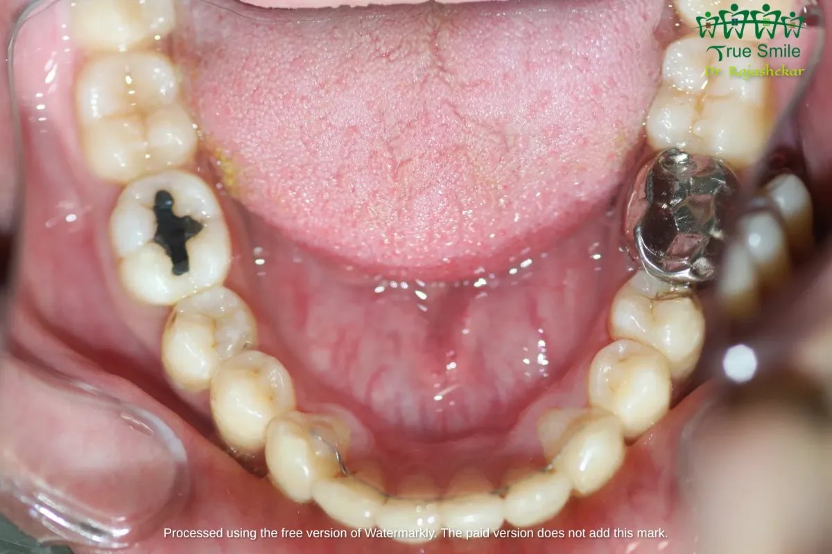 Case 6 — after Invisalign treatment