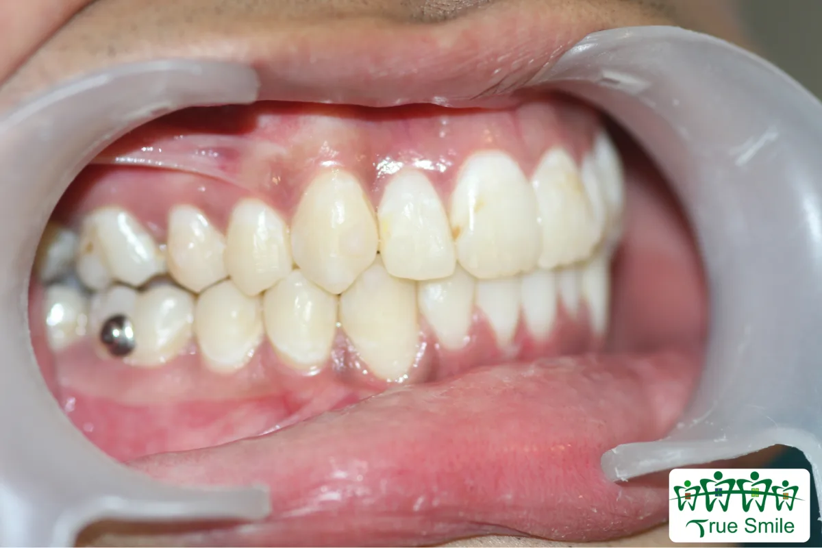 After orthodontic treatment