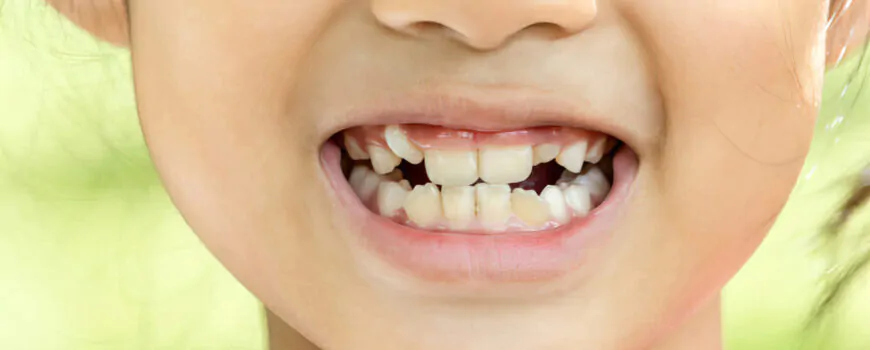 Illustration placeholder for mixed dentition orthodontic care