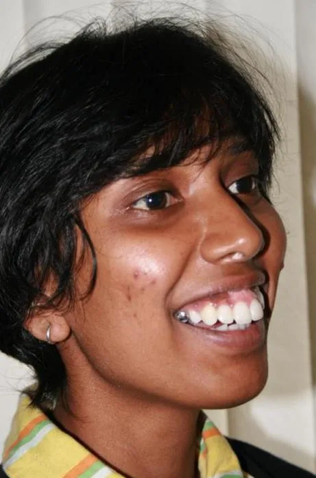 Before treatment smile view, case 4